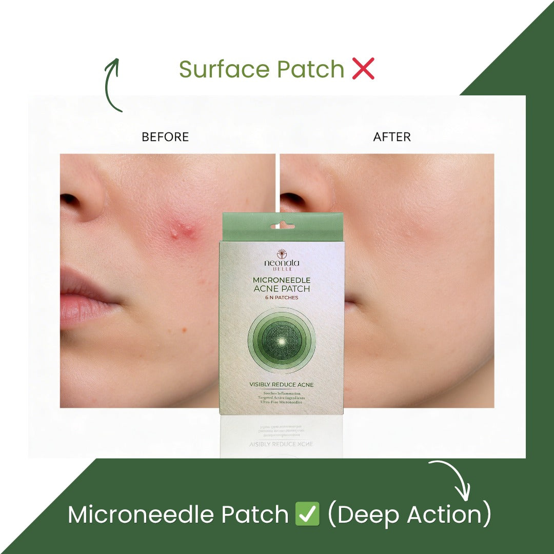 Neonata Belle Acne Patch | Hydrocolloid Pimple Patches for Overnight Spot Care (6 Dots)